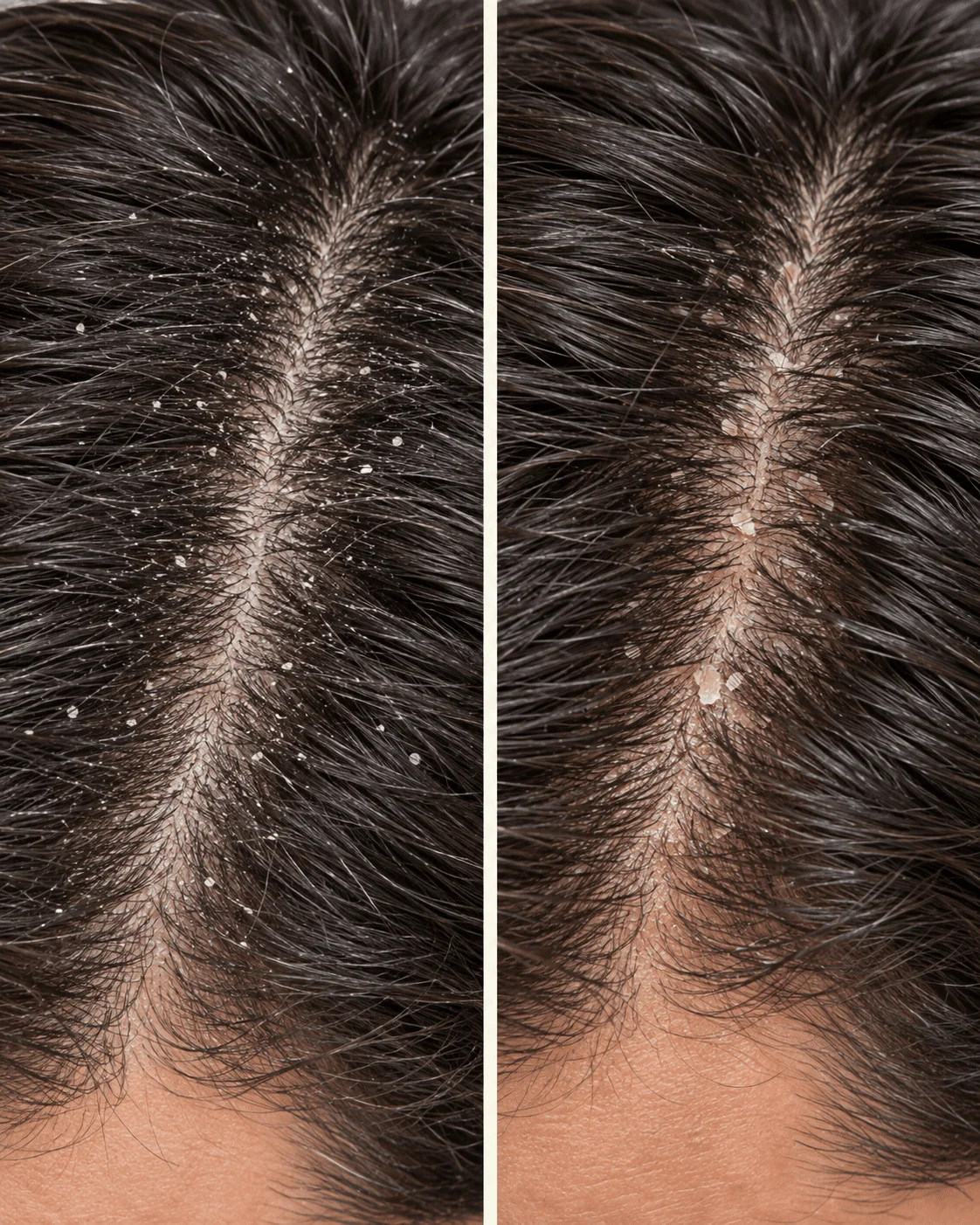 Comparación entre caspa seca y caspa grasa en hombre